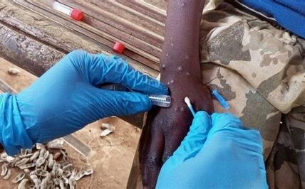 La OMS aprueba un test crucial para detectar mpox, mejorando la respuesta global ante brotes y controlando la propagación de la enfermedad.