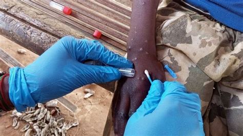 La OMS aprueba un test crucial para detectar mpox, mejorando la respuesta global ante brotes y controlando la propagación de la enfermedad.